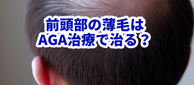 前頭部の薄毛はAGA治療で治る？