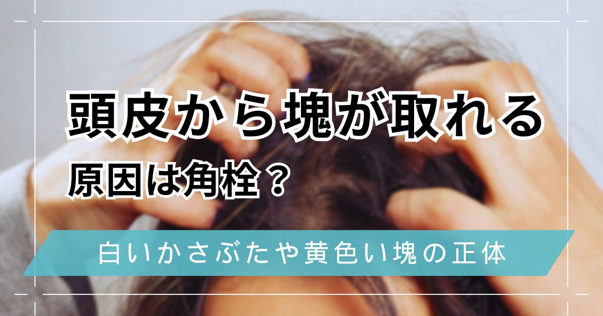 頭皮から塊が取れる原因は角栓？白いかさぶたや黄色い塊の正体についても解説