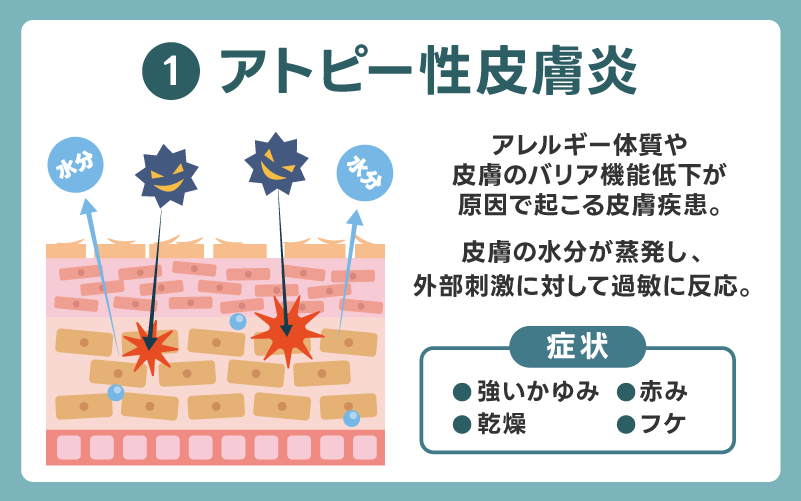 アトピー性皮膚炎によるかゆみ
