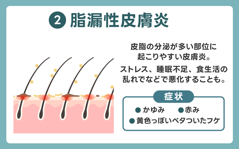 脂漏性皮膚炎によるかゆみ