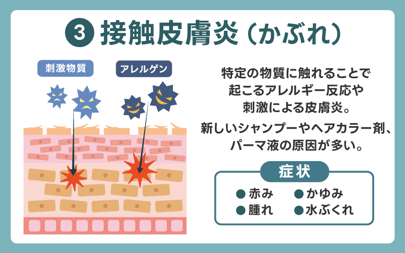 接触皮膚炎(かぶれ)によるかゆみ