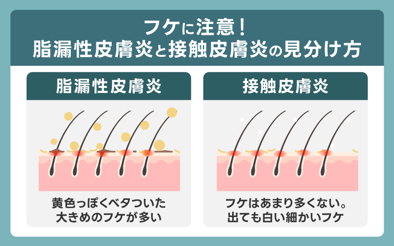 フケに注意!脂漏性皮膚炎と接触皮膚炎の見分け方