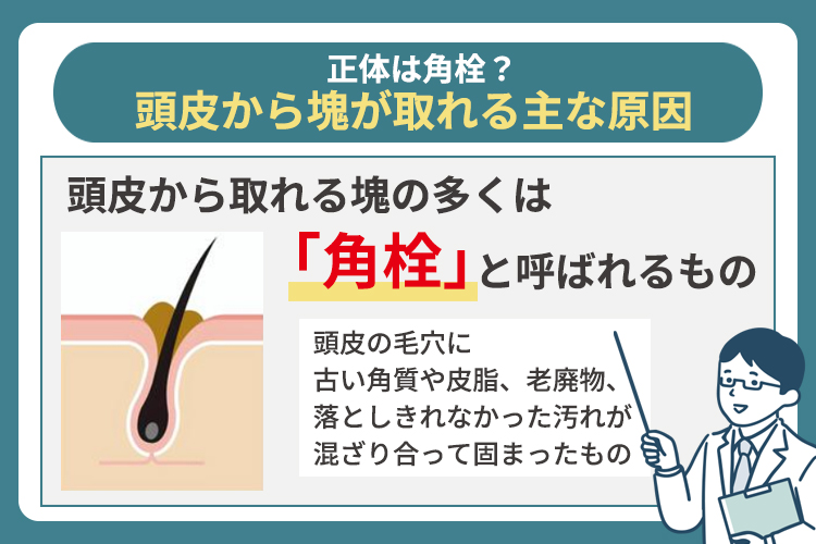 正体は角栓？頭皮から塊が取れる主な原因