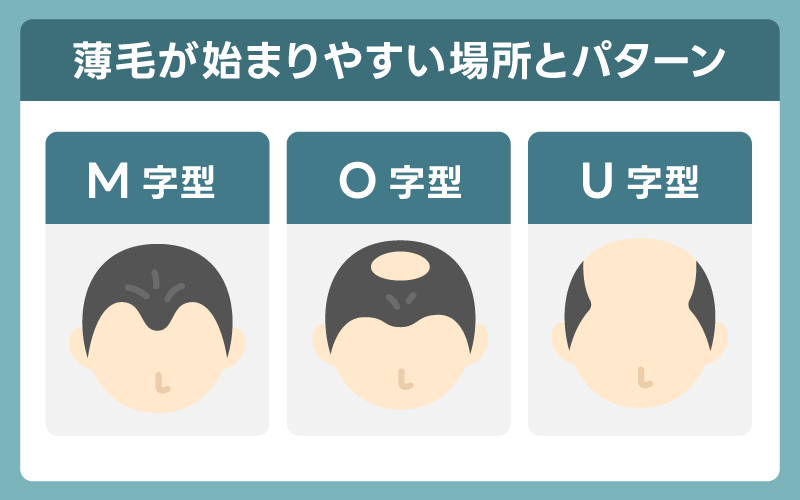 薄毛が始まりやすい場所とパターン