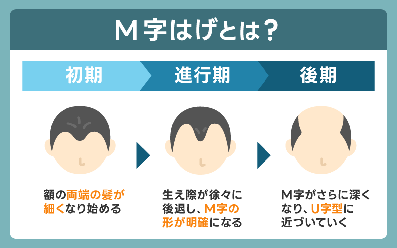 M字はげとはどんな状態？特徴を解説