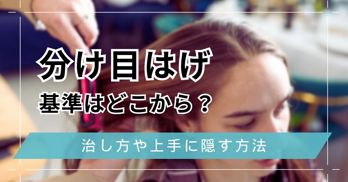 分け目はげの基準はどこから？治し方や上手に隠す髪型を男女別・年齢別に紹介