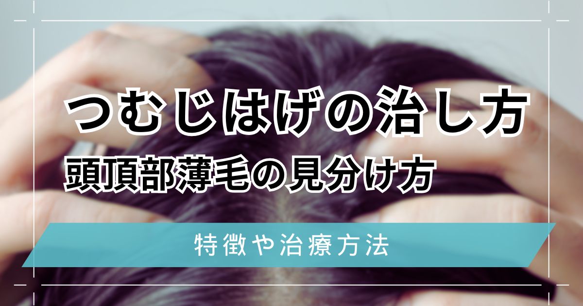 つむじはげの治し方5選！頭頂部薄毛の見分け方と特徴を解説