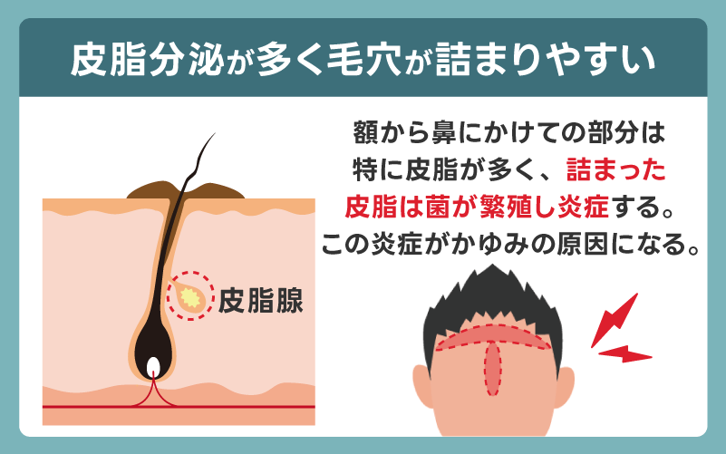 皮脂分泌が多く毛穴が詰まりやすい