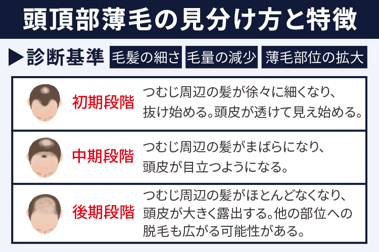 頭頂部薄毛の見分け方と特徴