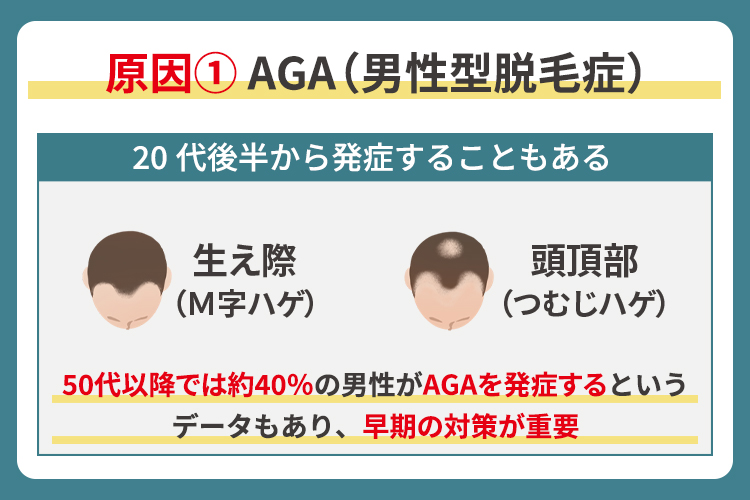 原因① AGA（男性型脱毛症）