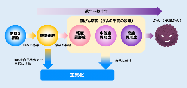 子宮頸がん検診